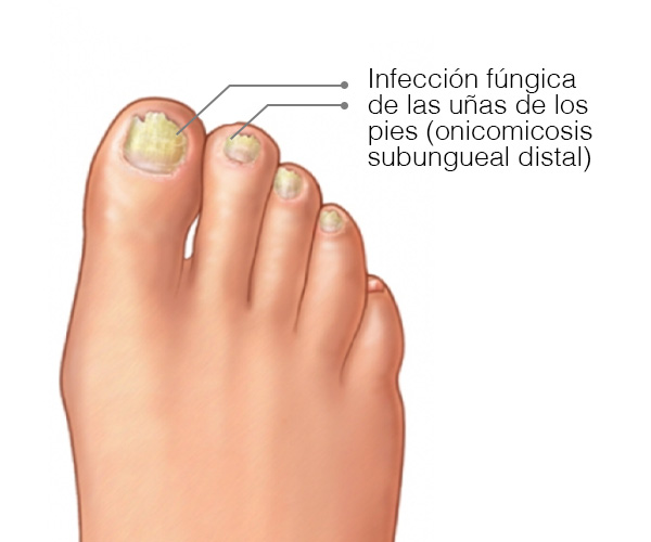 Clases de hongos en las uñas de los pies