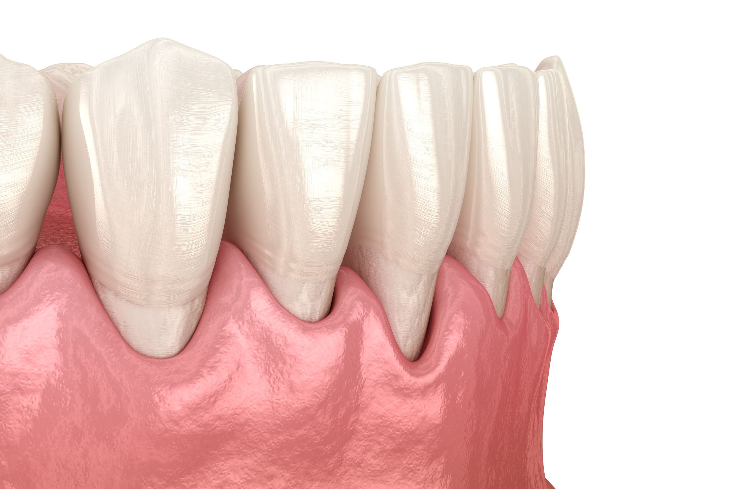 ¿Como fortalecer un diente que se mueve?