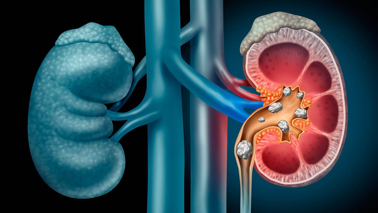 ¿Como quitar el dolor del cólico de riñón?