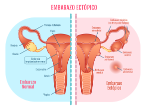 Dolor de ovarios en el embarazo primer trimestre