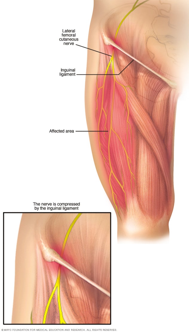dolor-en-el-muslo-derecho-parte-lateral
