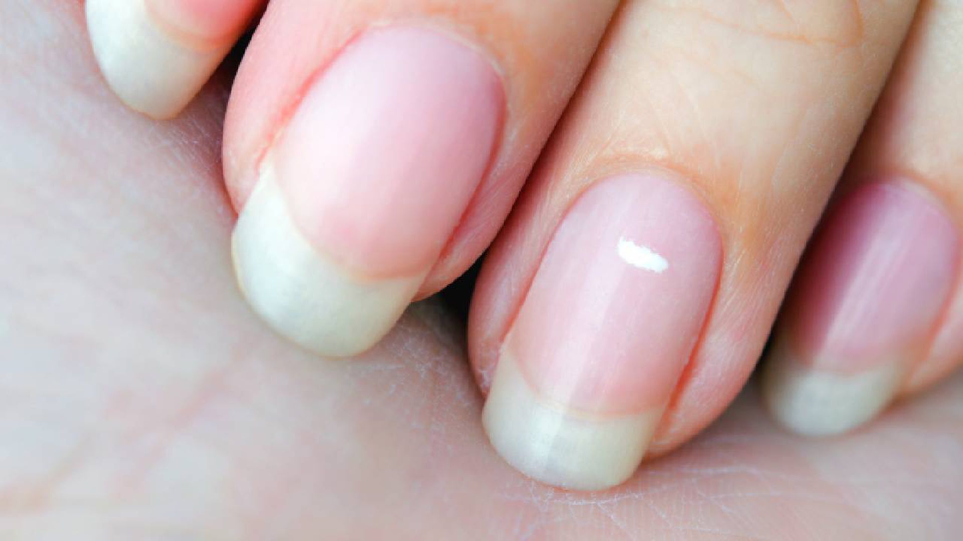 ¿Que vitamina falta cuando salen manchas blancas en las uñas?