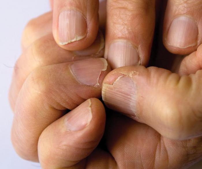 Remedios caseros para uñas quebradizas y escamadas