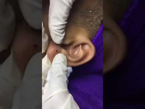 ¿Como quitar bulto en el lóbulo de la oreja?