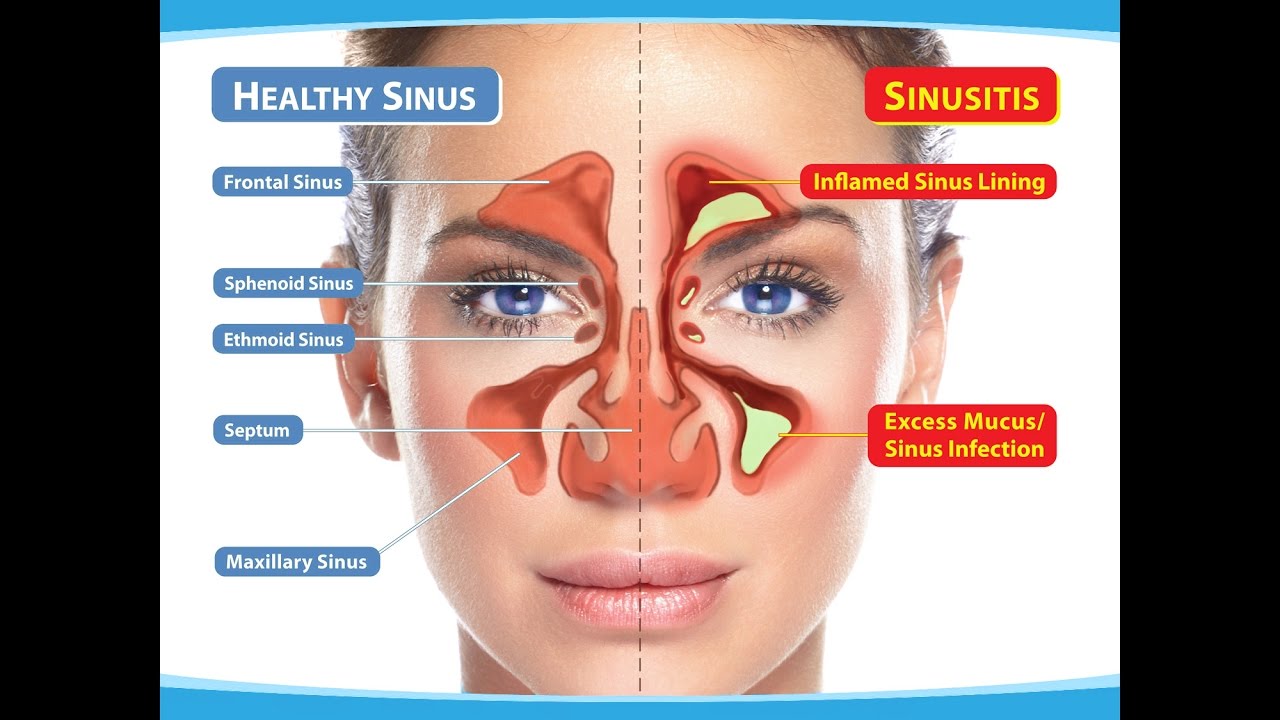 ¿Como quitar el dolor de cabeza por sinusitis?