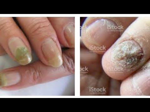 Fotos de hongos en las uñas de las manos