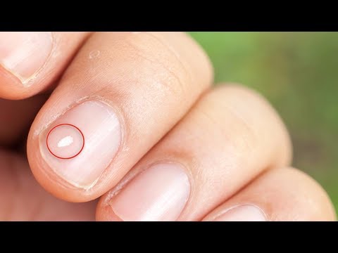 Nombre de las manchas blancas que salen en las uñas